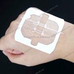 Zip Medical Sterile Skin Closure Device
