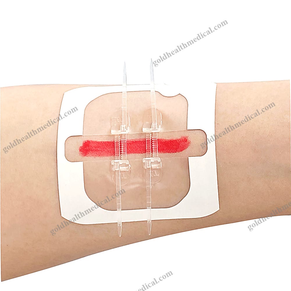 Wound Closure Zipper Device with PU Dressing