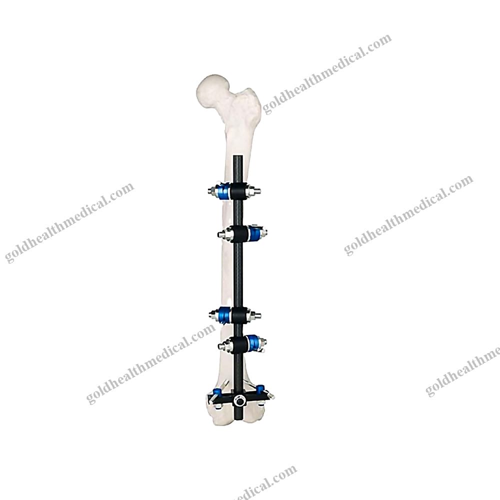 TType AO External Fixation System for Orthopedic Surgery