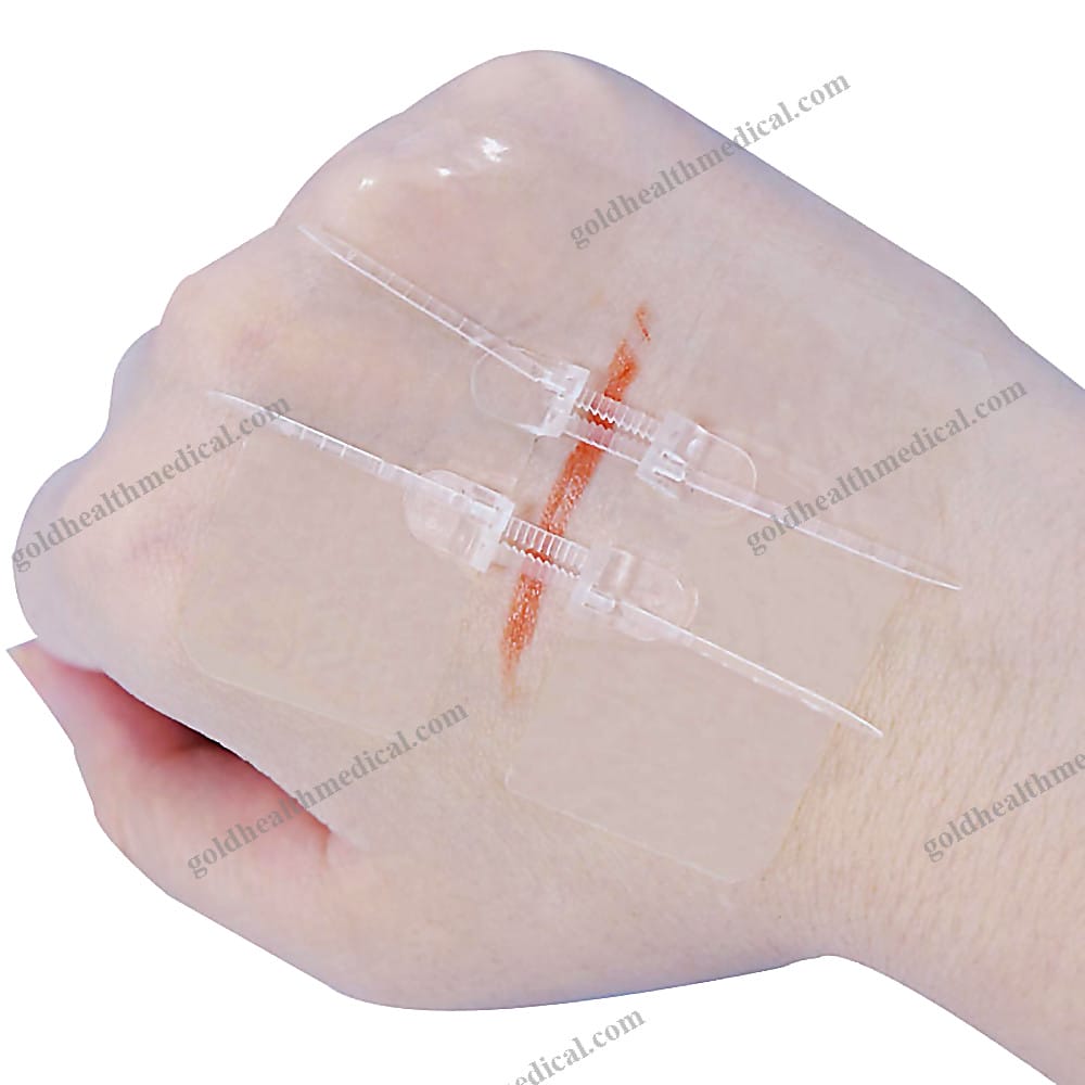 CEApproved Zip Stitch for Surgical Wound Closure