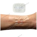 ZipStrips Wound Closure Device