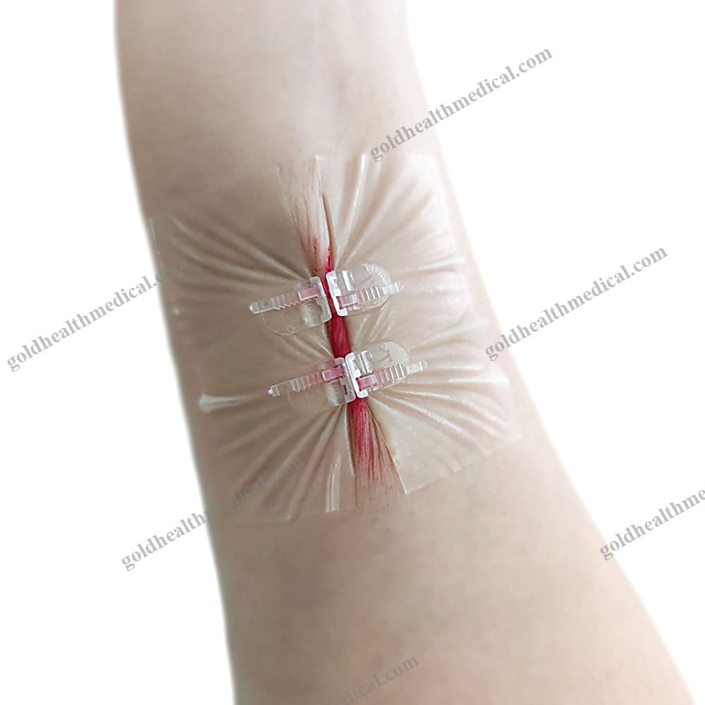 Advanced Skin Closure Strips for Surgical Wounds