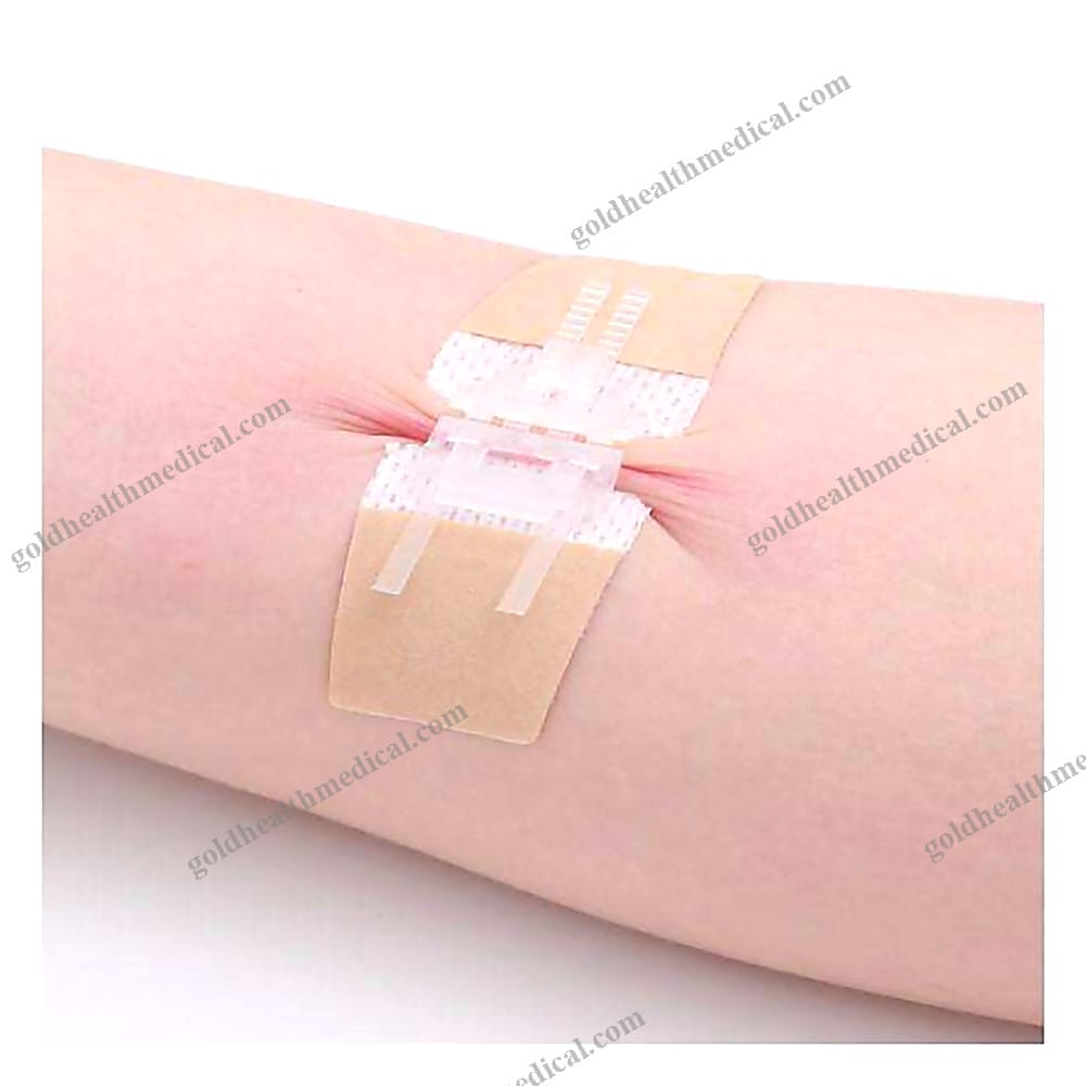 NonInvasive Zipper Skin Closure Device
