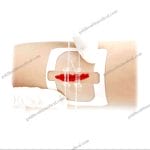 Reinforced Sterile Skin Closure Stapler