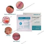 Hydrocolloid Dressings for Bed Sores