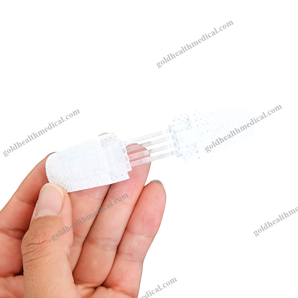Zip Stitch Sutures for Painless Wound Closure