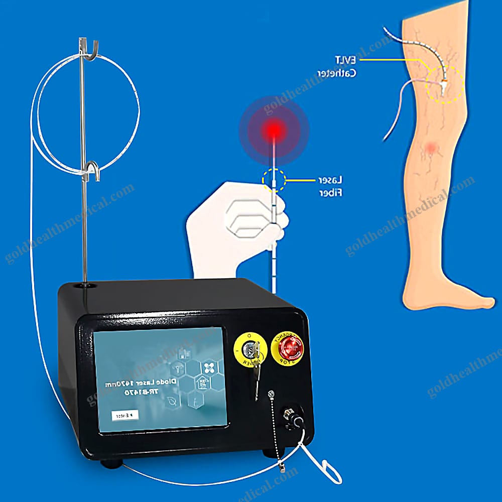 1470nm Endovenous Laser Ablation System for Ph