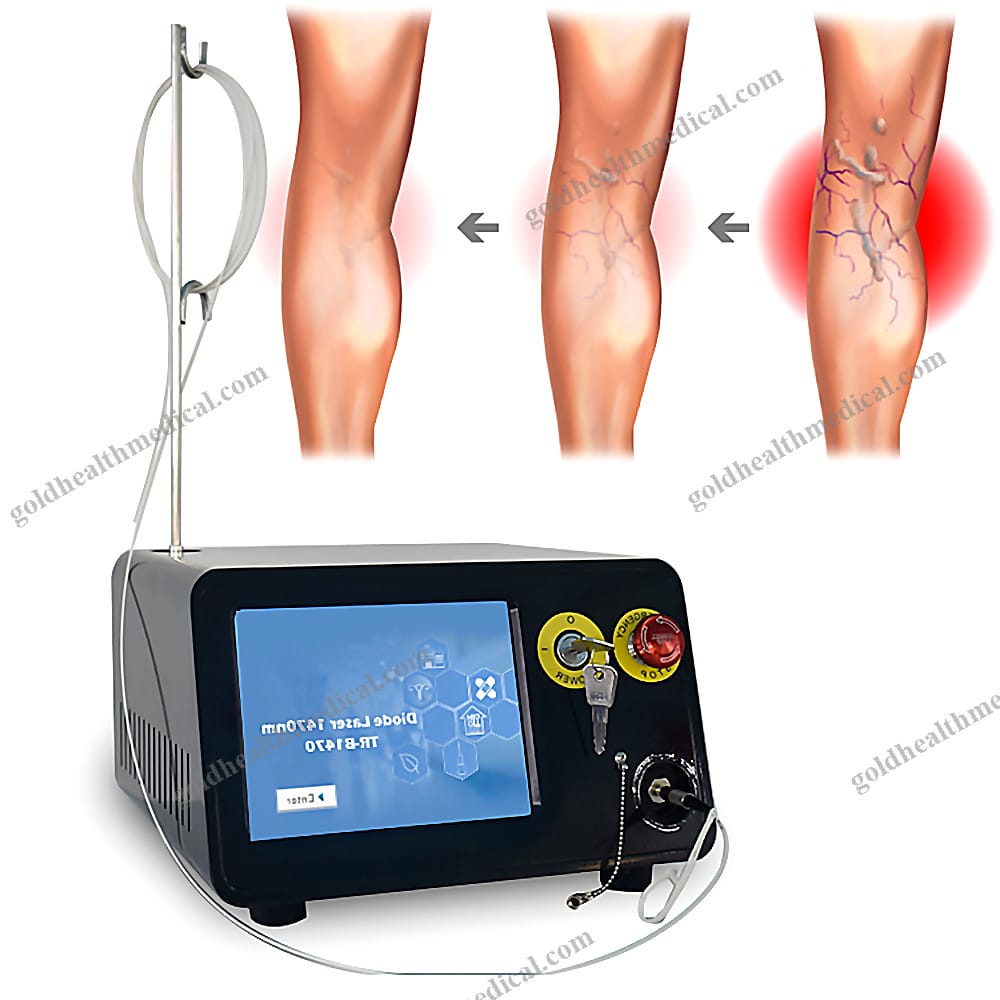 EVLT Surgery Laser 1470nm Vein Ablation