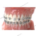 Premium Steel Orthodontic Bracket System with Advanced Electric Power Supply