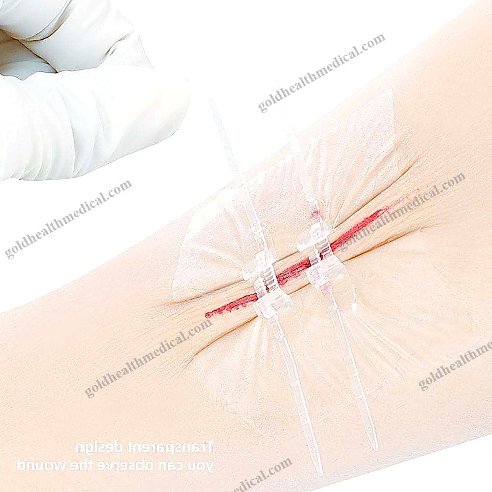 SteriStrip Wound Closure for Small Cuts and Wounds Without St