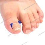 Premium Toenail Correction Patch